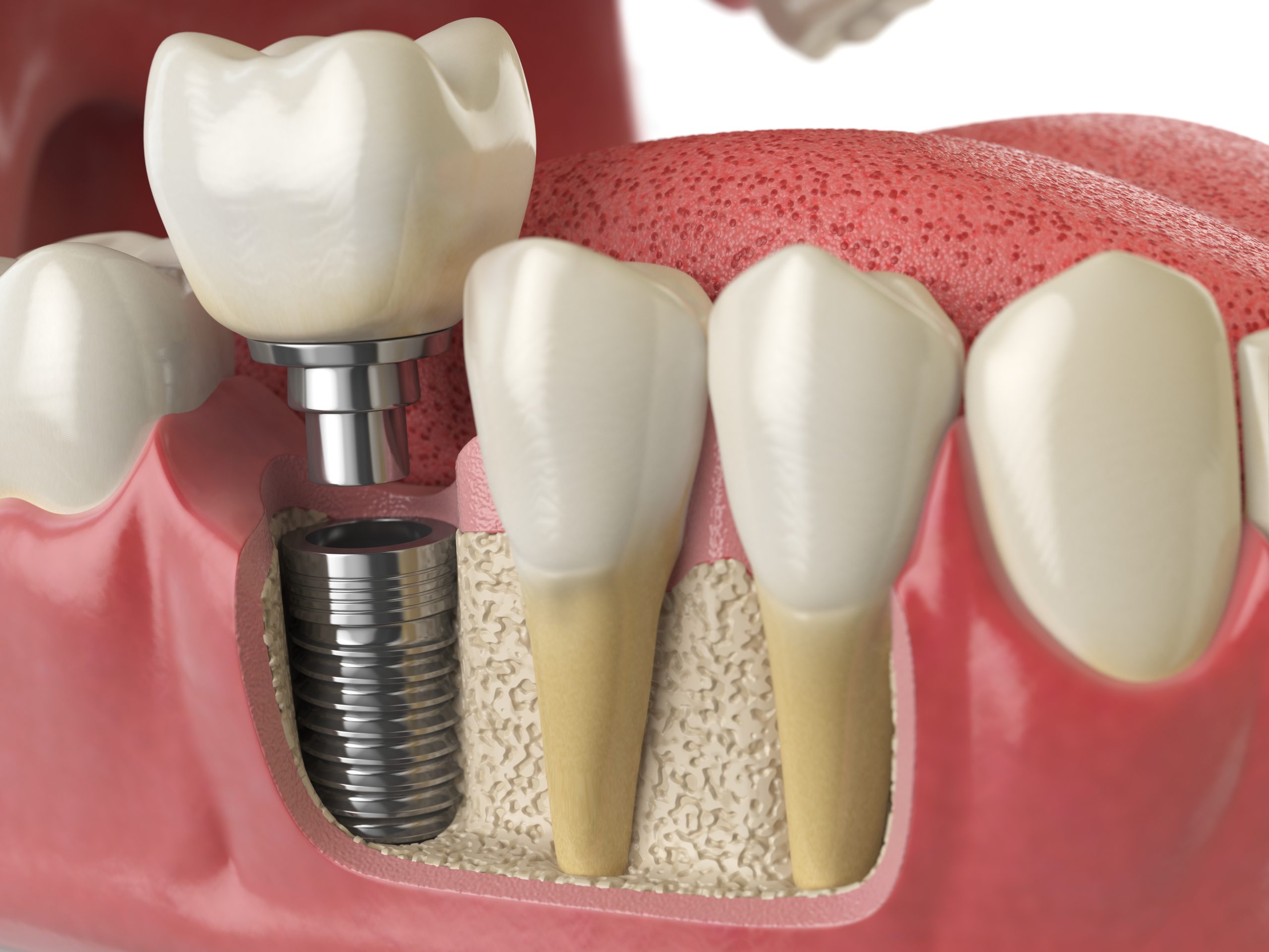 Smile Transformation Through Dental Implants